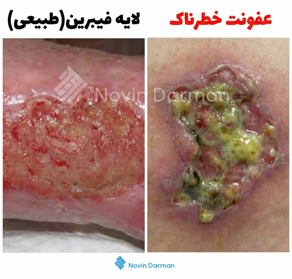 تفاوت فیبرین طبیعی زخم با عفونت زخم جراحی