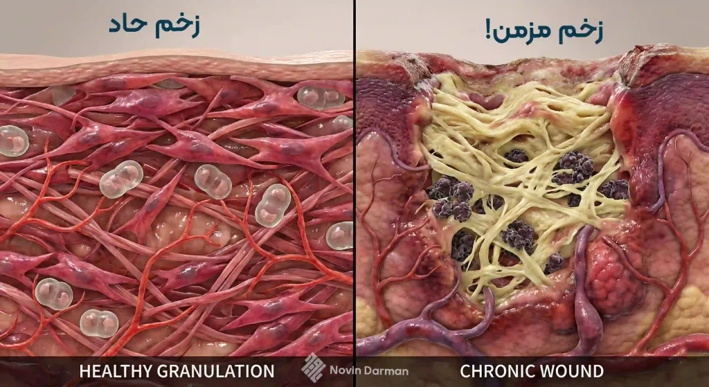 بیوفیلم زخم مزمن
