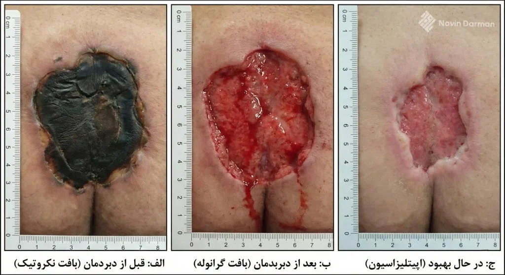 دبریدمان زخم بستر نکروزه