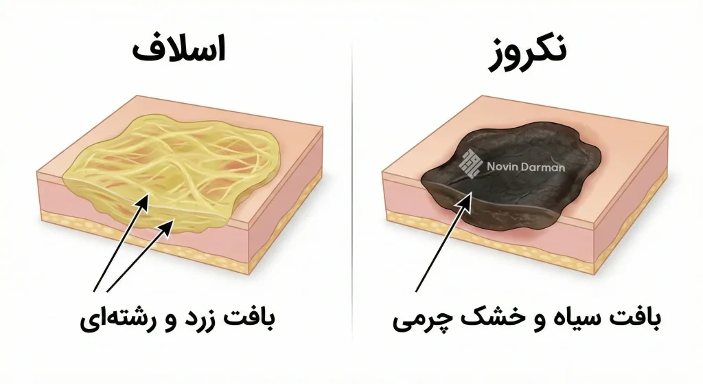 تفاوت اسلاف و نکروز در زخم بستر و دیابتی