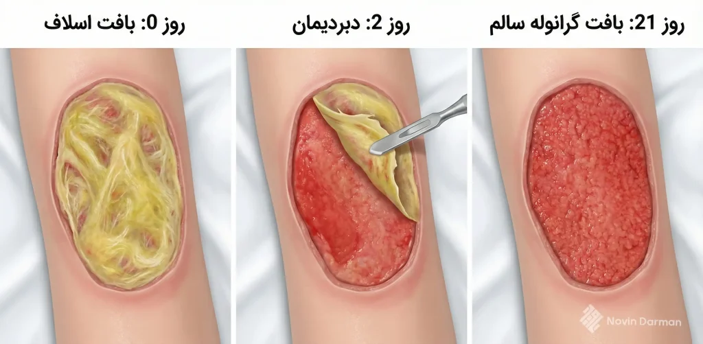 بافت گرانوله بعد از دبریدمان زخم مزمن موفق