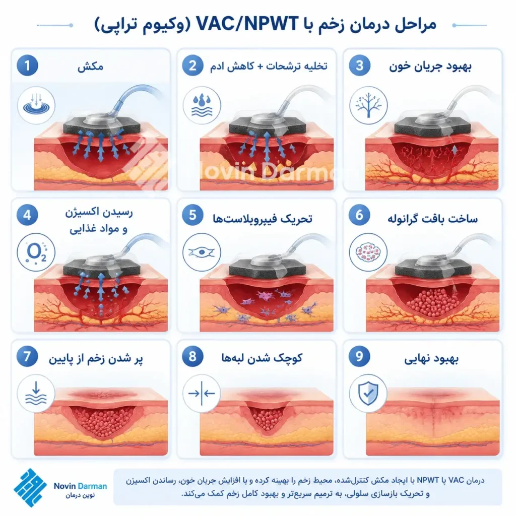 مراحل عملکرد وکیوم تراپی زخم