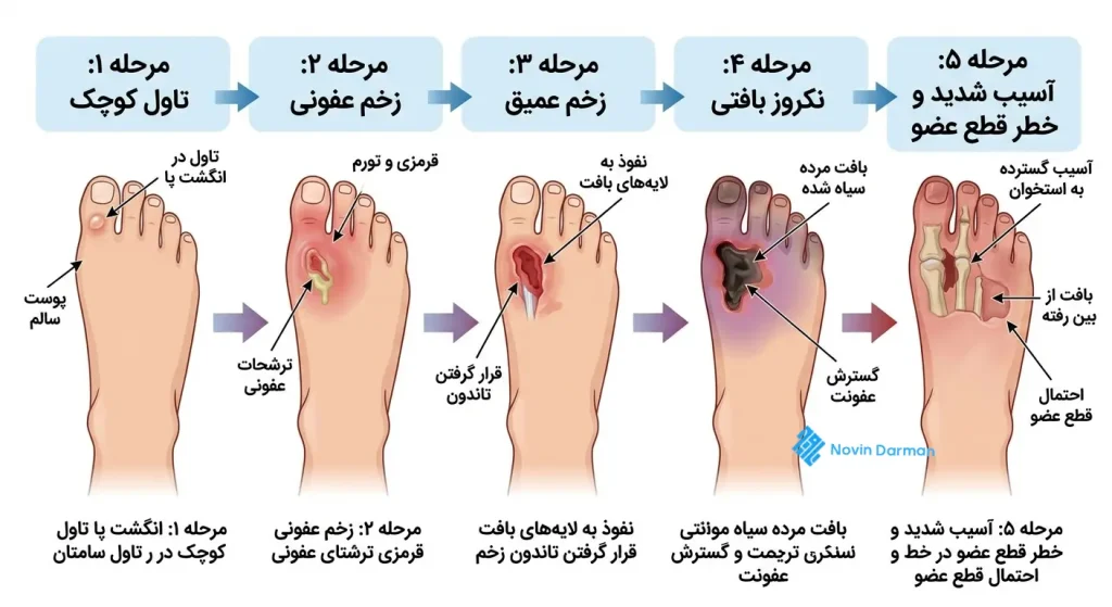 مراحل پیشرفت زخم پای دیابتی از آسیب پوستی تا خطر قطع عضو