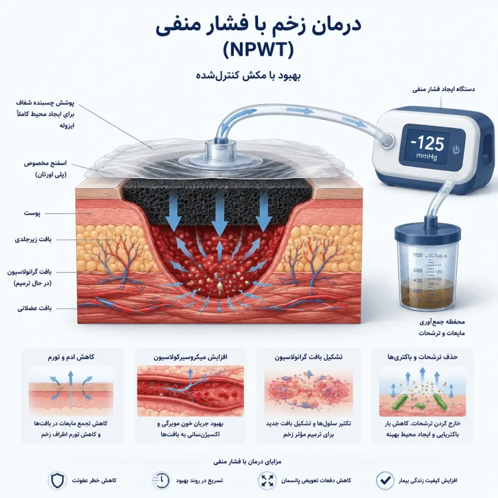 وکیوم تراپی زخم در اصفهان