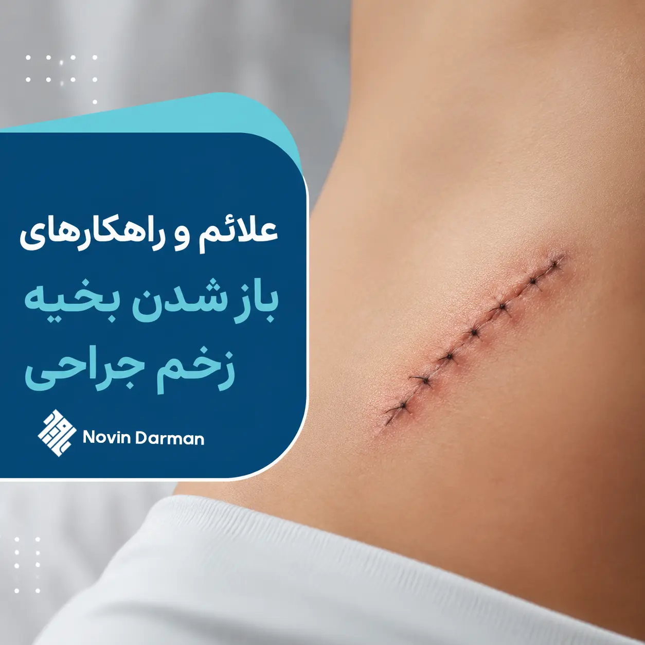 باز شدن بخیه زخم جراحی