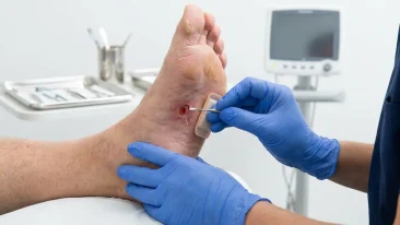 جلوگیری از قطع عضو دیابتی با تشخیص زودهنگام و درمان زخم پای دیابتی